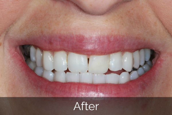 Invisalign straightening treatment after photo