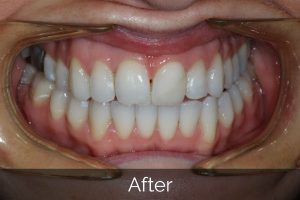 Image of teeth after Invisalign straightening treatments