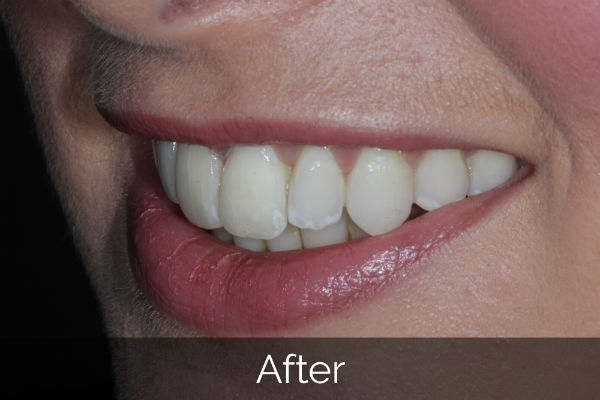 Six Month Smile