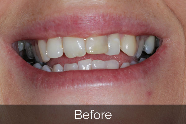 Invisalign straightening before treatment photo