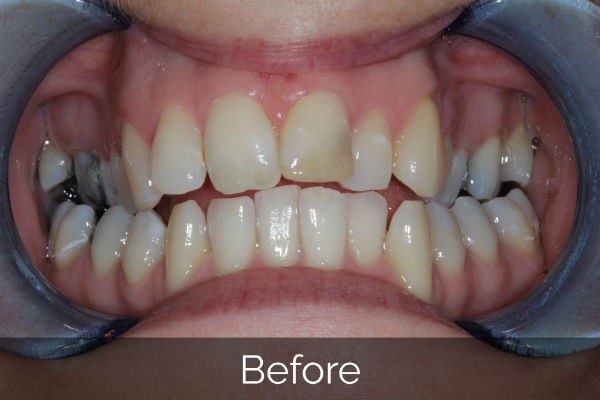 Invisalign before treatment photo