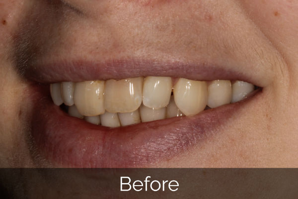 Six Month Smile