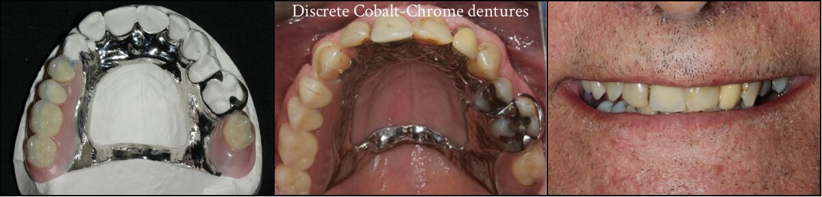 Discrete cobalt chrome dentures - photo of them out of mouth and in place