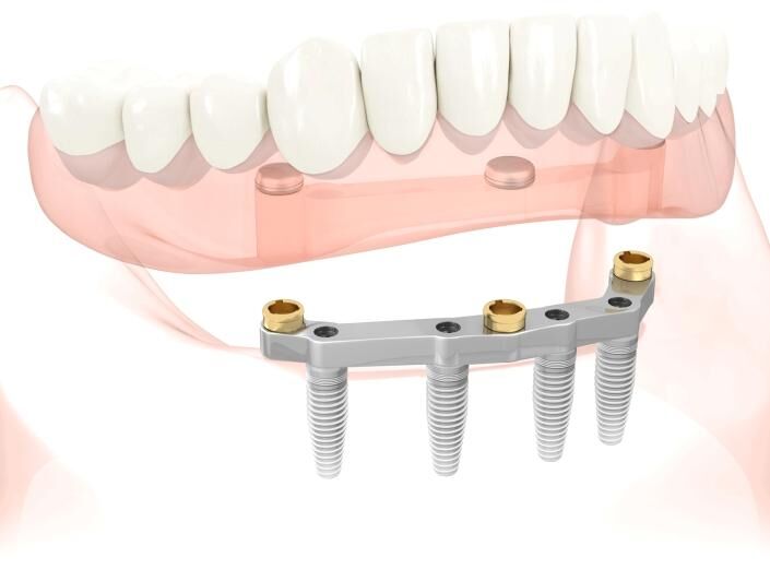 Implant retained denture diagram