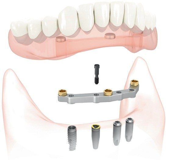 Implant retained denture diagram showing how they are screwed in
