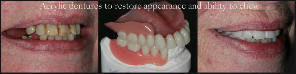 Acrylic dentures photo of before and after treatment