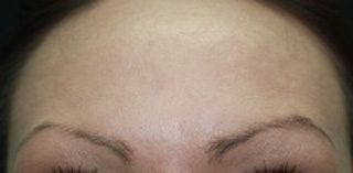 Facial rejuvenation botox after photo