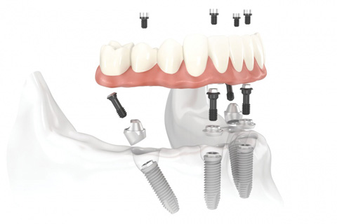 All on 4 Implant System