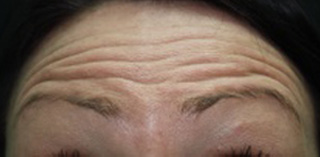 Facial rejuvenation forehead before photo