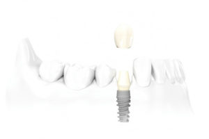Diagram of dental implants with screw fixing