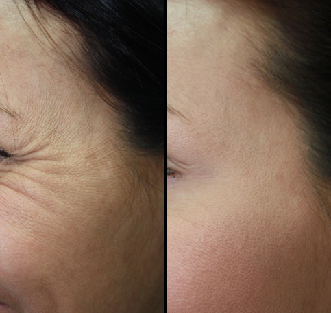 Facial rejuvenation eye treatment before and after photos