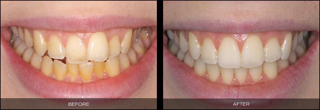 Inman Aligners