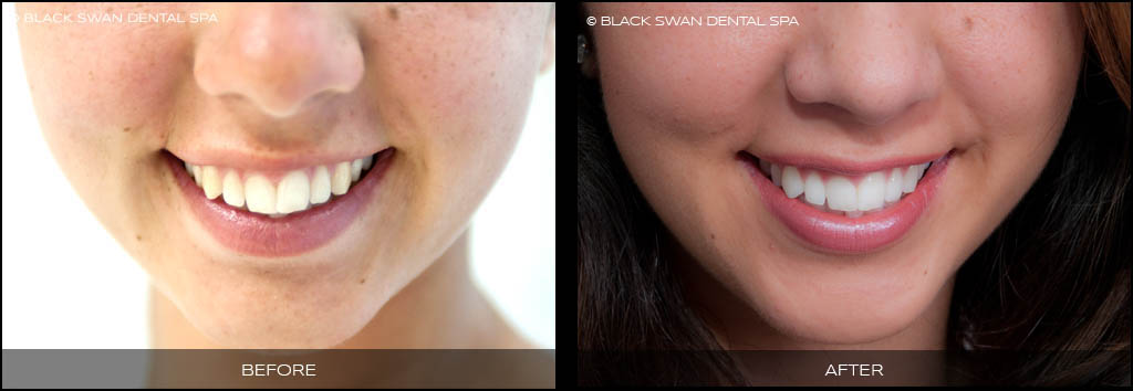 Tooth Whitening